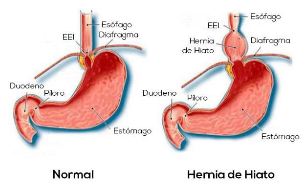 La hernia se como que hiatal y cura es